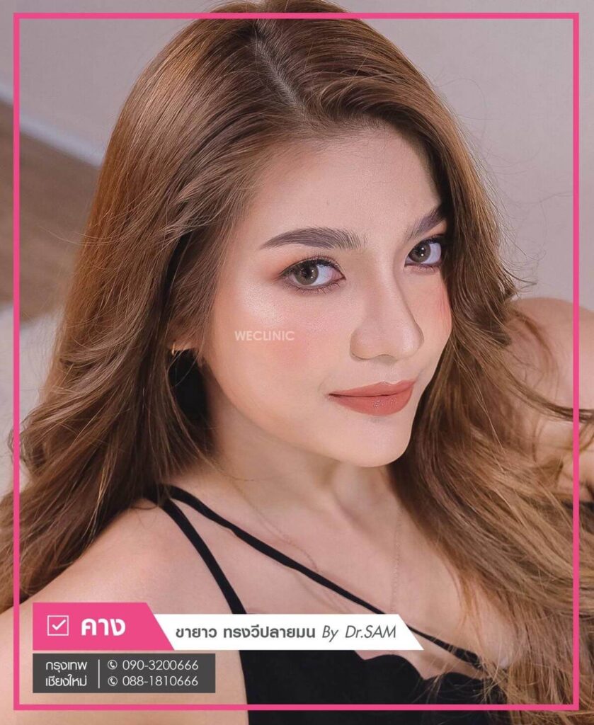 เสริมคางแผลนอก-we-clinic