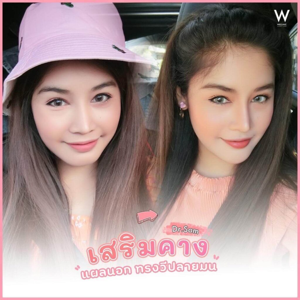เสริมคางแผลนอก-ทรงวี-ปลายมน-คืออะไร-ดีไหม