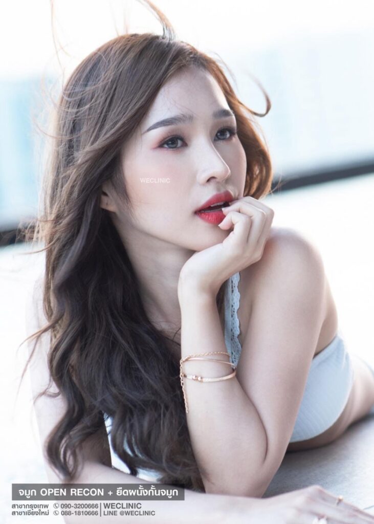 รีวิวเสริมจมูก-จมูกสั้น-เนื้อจมูกน้อย