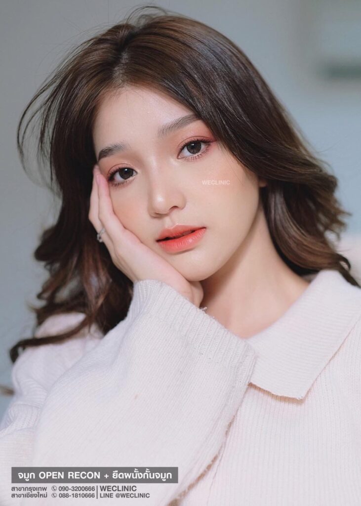 รีวิวเสริมจมูกเนื้อน้อย