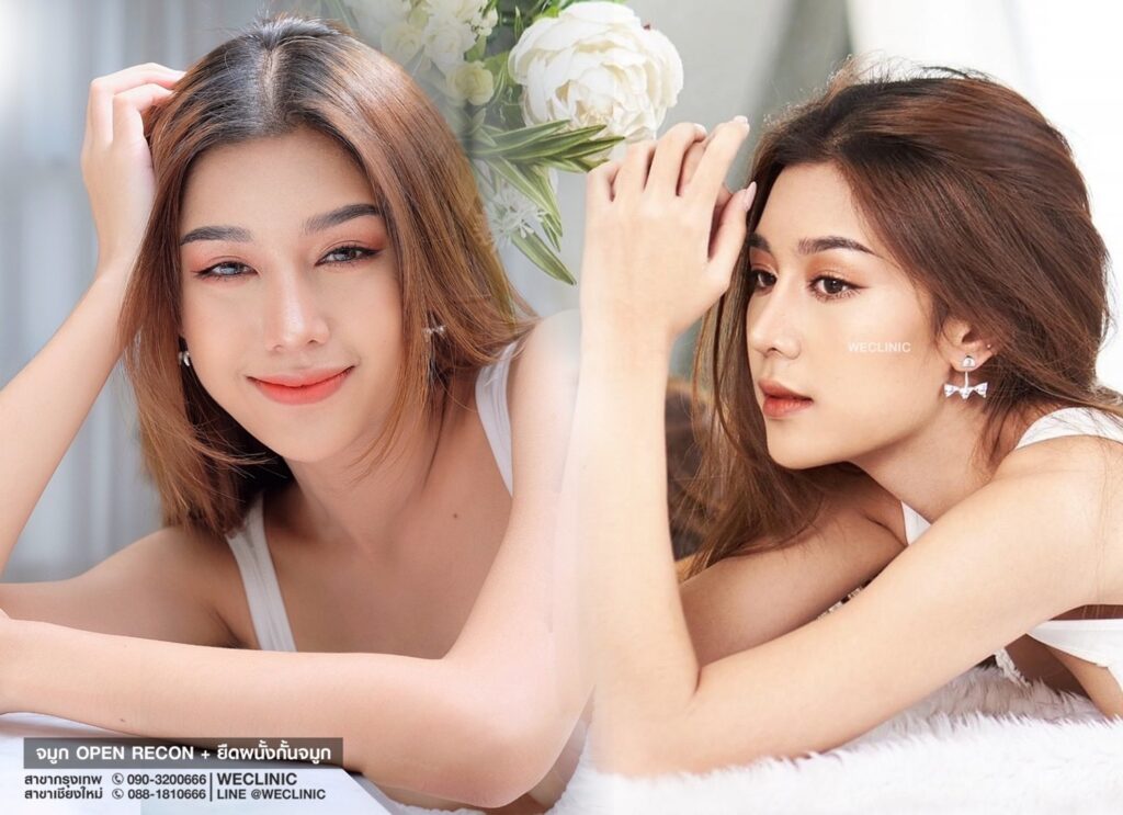 รีวิวเสริมจมูกเนื้อน้อย-ด้วยเทคนิค-Open-ยืดผนังกั้นจมูก