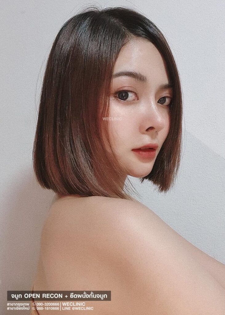 รีวิวเสริมจมูกเนื้อน้อย-ด้วยเทคนิคเสริมจมูกแบบโอเพ่น