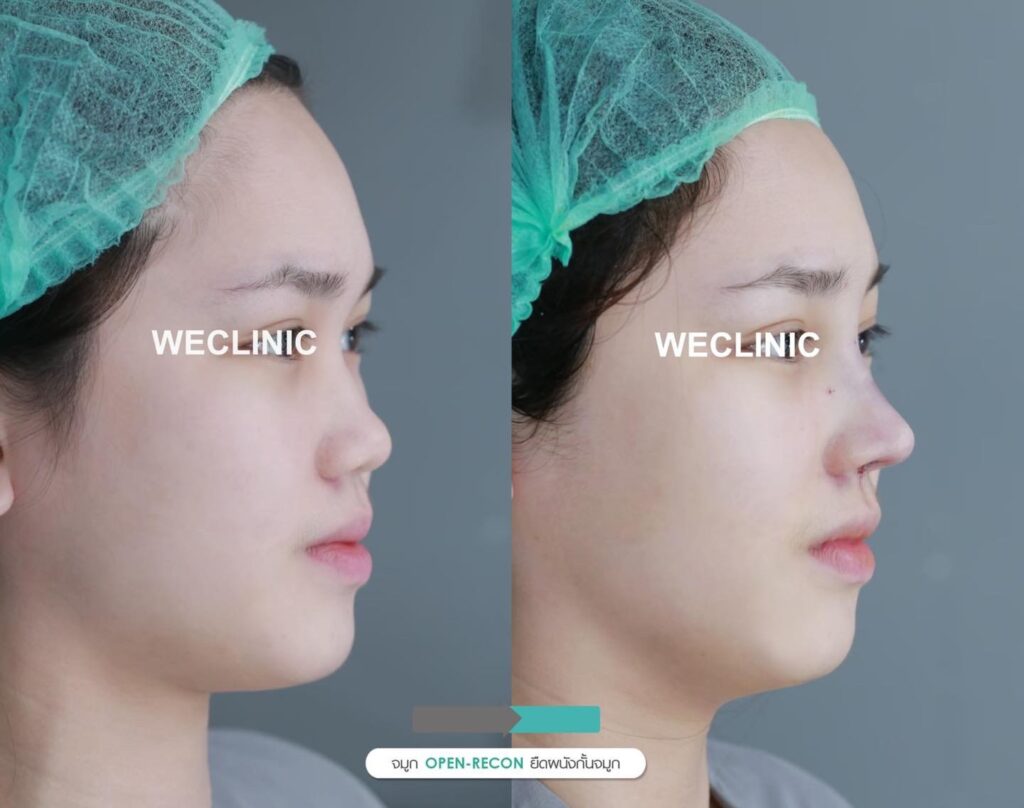 เนื้อจมูกน้อย-จมูกสั้น-ดูยังไง