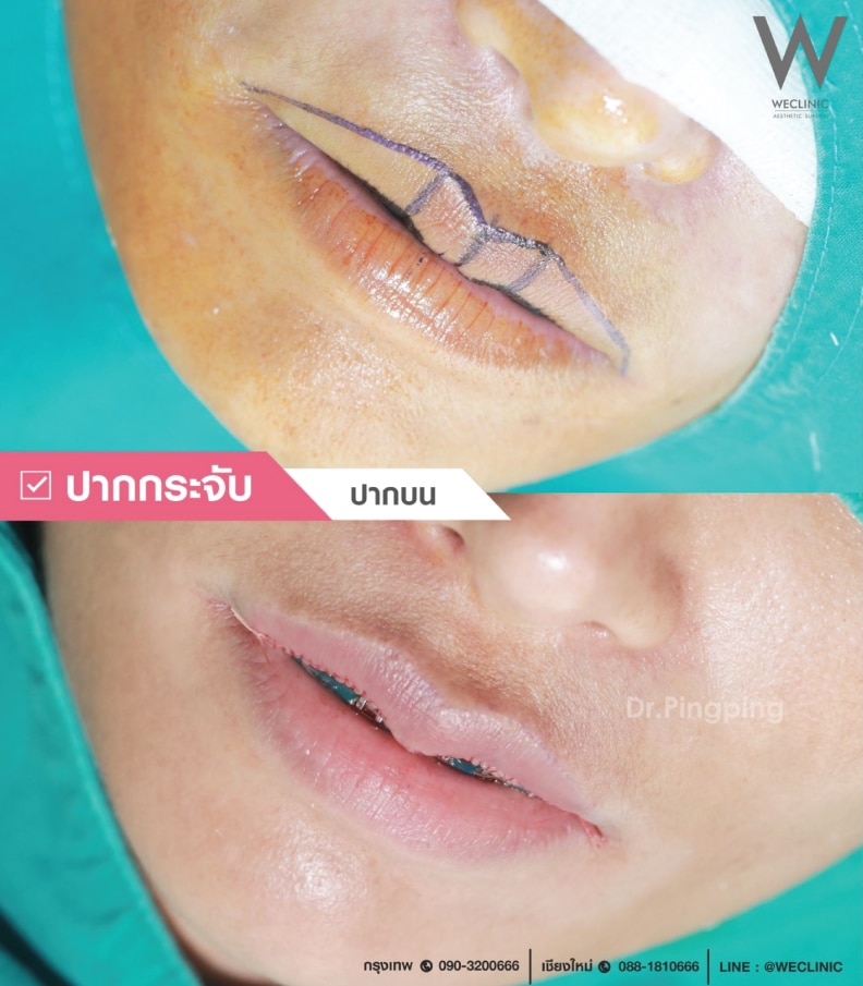 ทําปากกระจับ ราคาถูก ราคาแพง ต่างกันอย่างไร