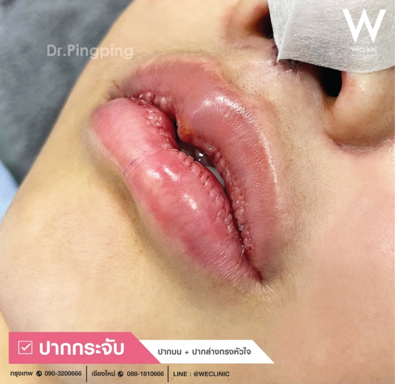 ทําปากกระจับ ราคาเท่าไหร่