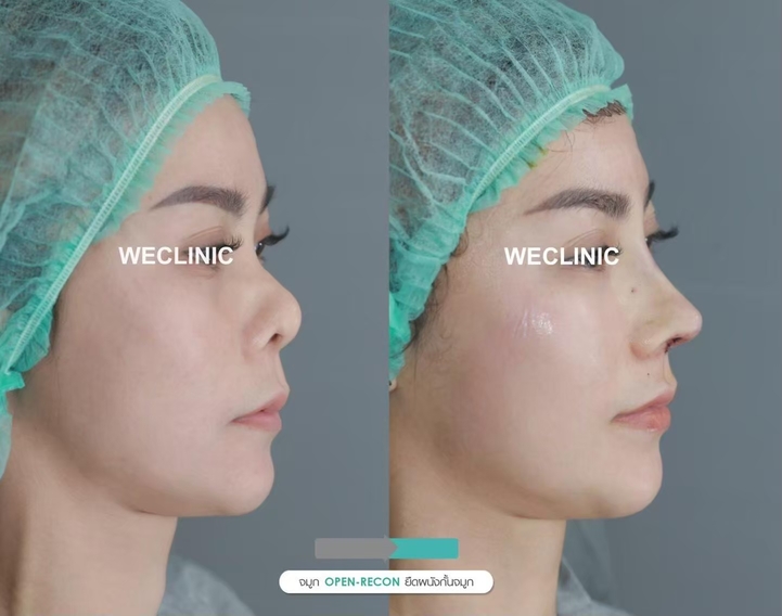 before after nose surgery-1