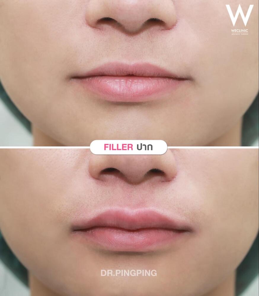 ฉีดฟิลเลอร์ปากกระจับ