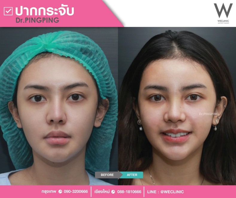 รีวิวทรงปากกระจับ