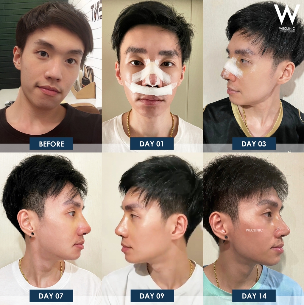 รีวิวหลังเสริมจมูก 14 วัน