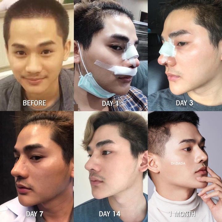 รีวิวหลังเสริมจมูก 3 เดือน 90 วัน