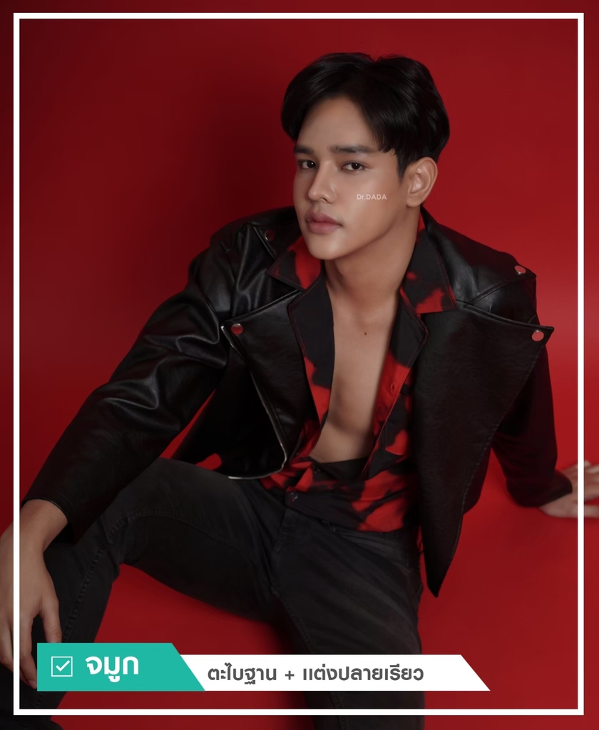 รีวิวเสริมจมูกผู้ชาย-2