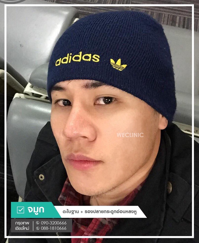 รีวิวเสริมจมูกผู้ชาย-4