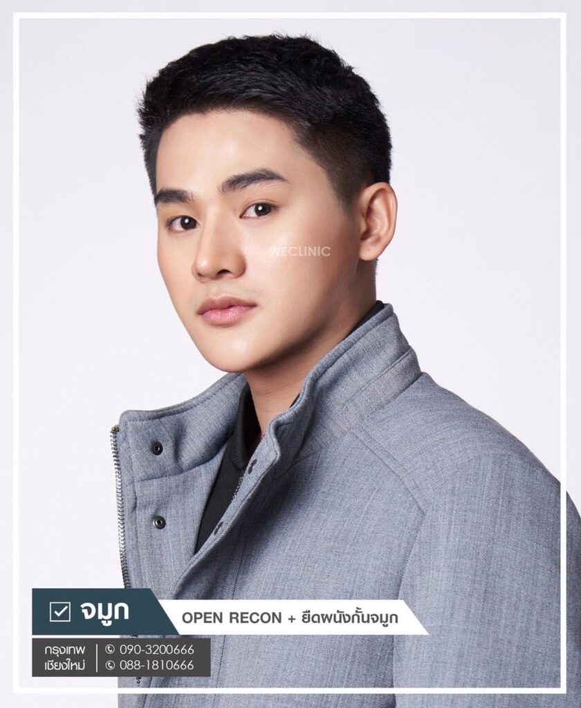 เสริมจมูกผู้ชาย ทรงจมูกเกาหลี