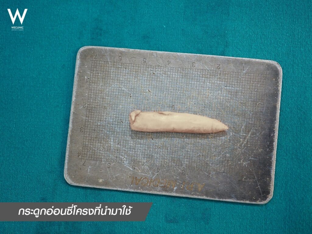 กระดูกอ่อนซี่โครงที่นำมาใช้