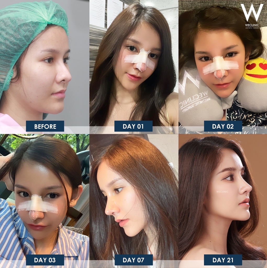 การดูแลหลังเสริมจมูกกระดูกอ่อนซี่โครง