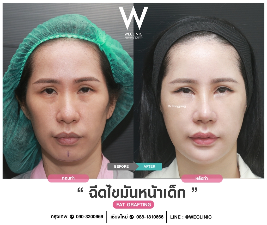 ก่อนหลังเติมไขมันหน้า-case-1-F08