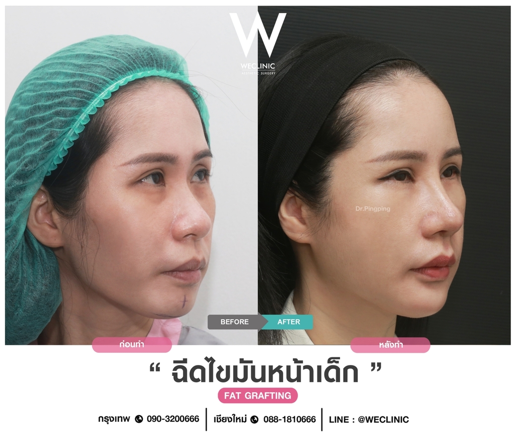 ก่อนหลังเติมไขมันหน้า-case-1-F09