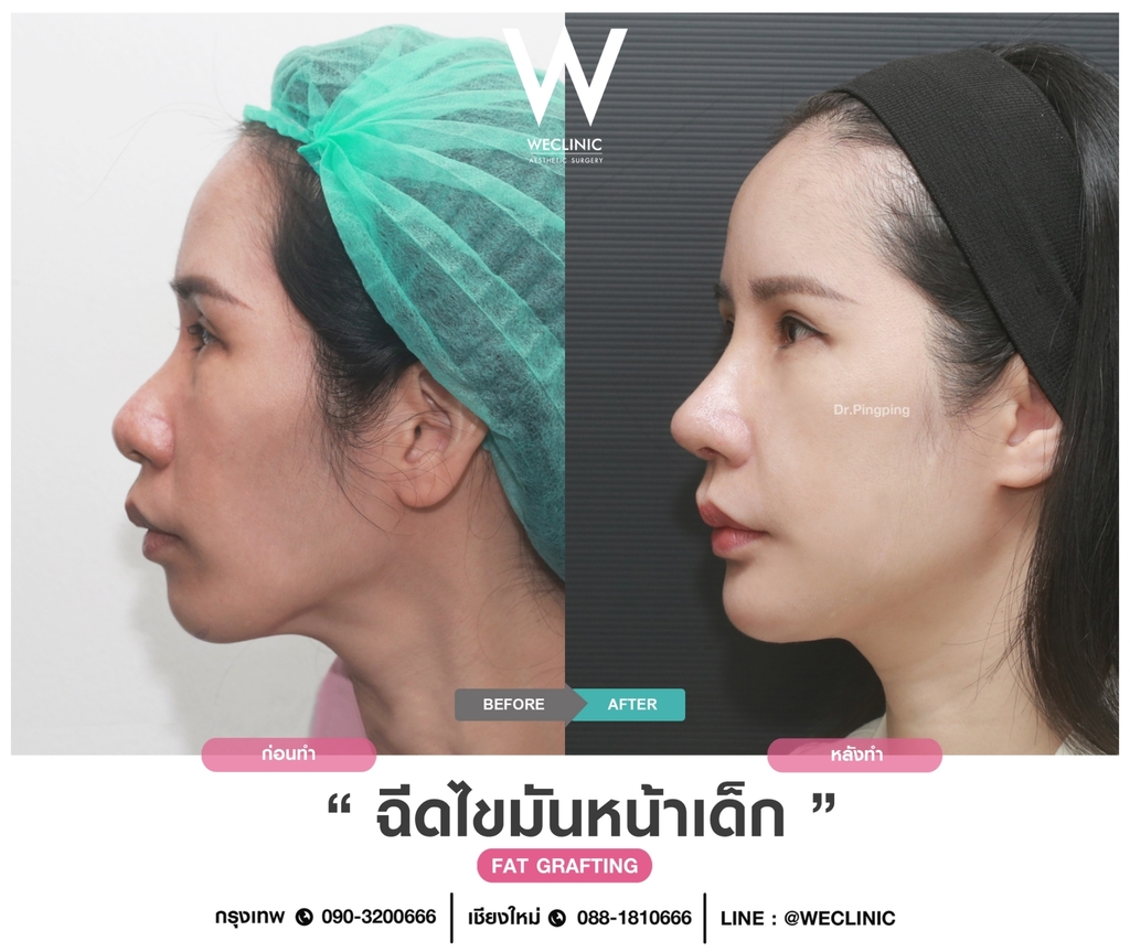 ก่อนหลังเติมไขมันหน้า-case-1-F10