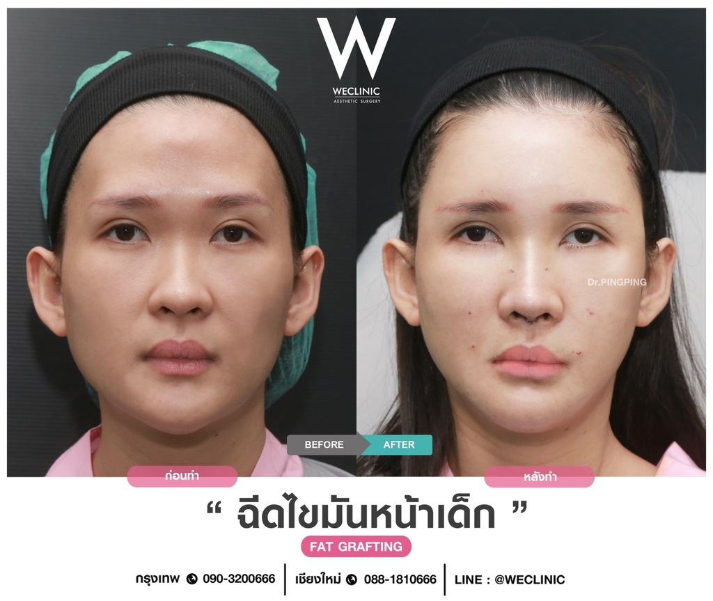 ก่อนหลังเติมไขมันหน้า-case-2-