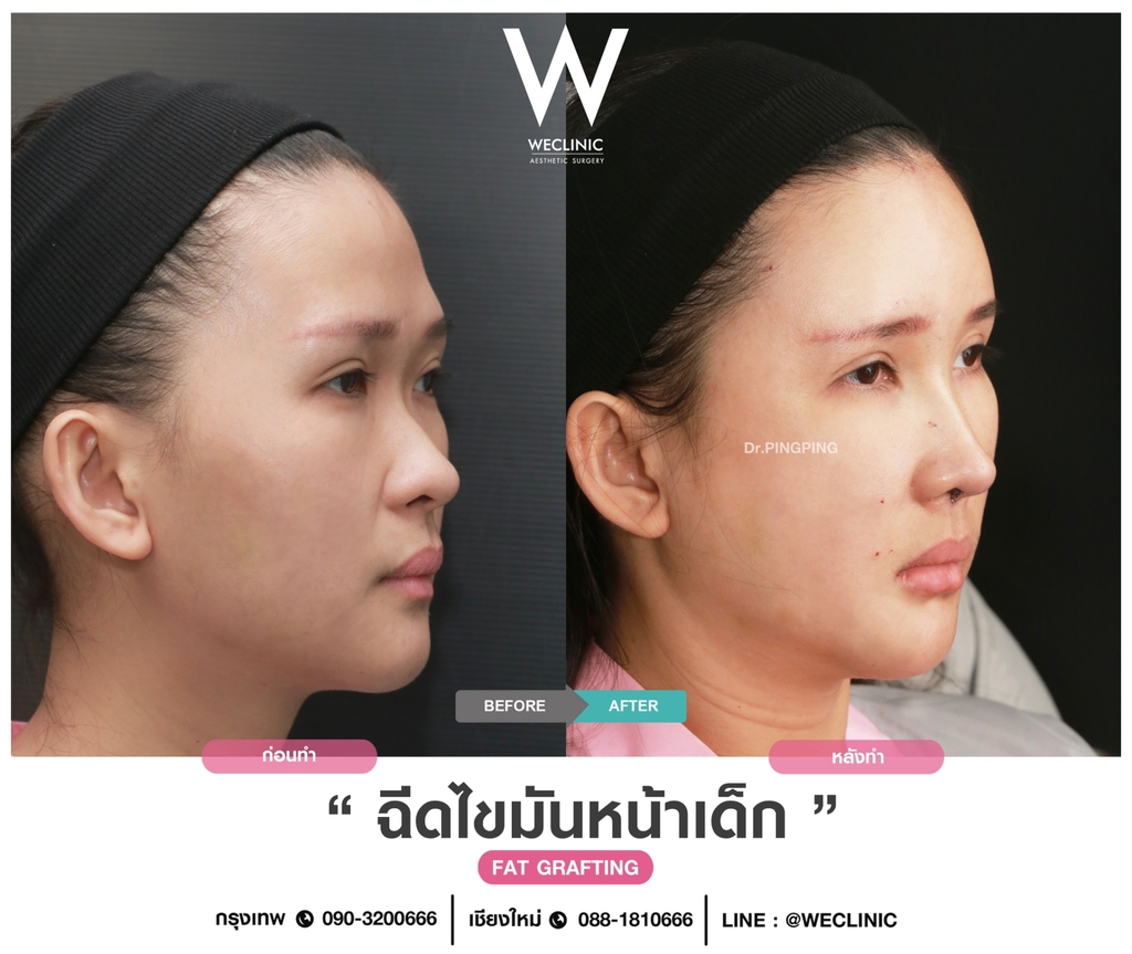 ก่อนหลังเติมไขมันหน้า-case-2-F13