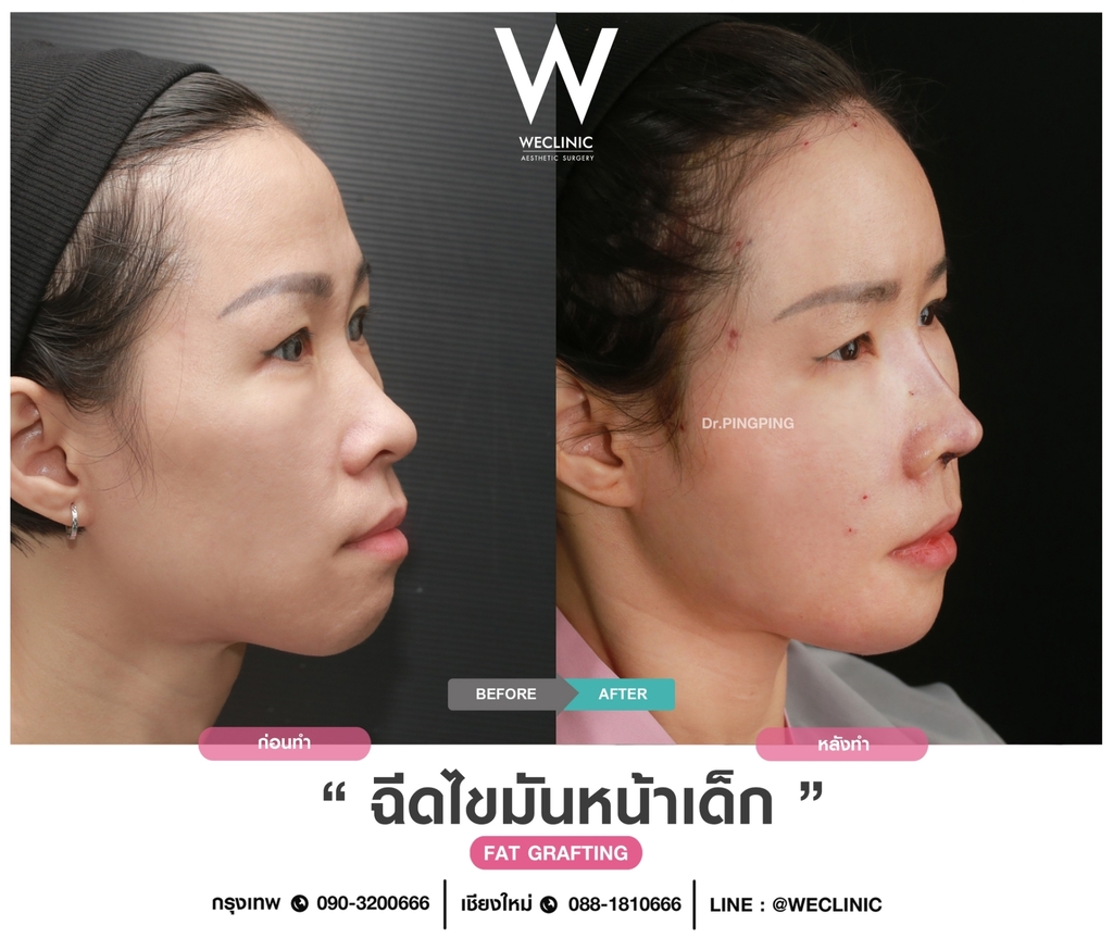 ก่อนหลังเติมไขมันหน้า-case-2-F17