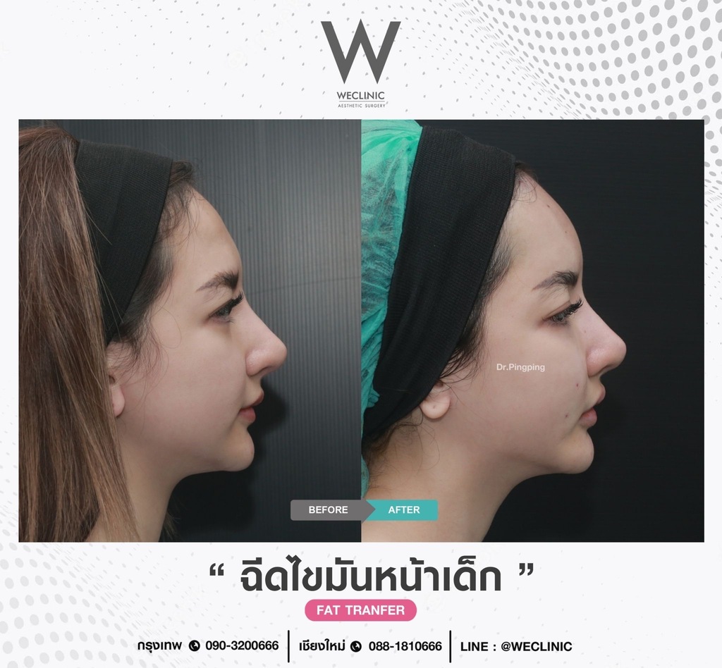 ก่อนหลังเติมไขมันหน้า-case-3-F19