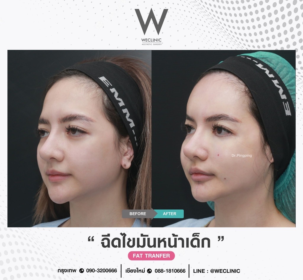 ก่อนหลังเติมไขมันหน้า-case-3-F20