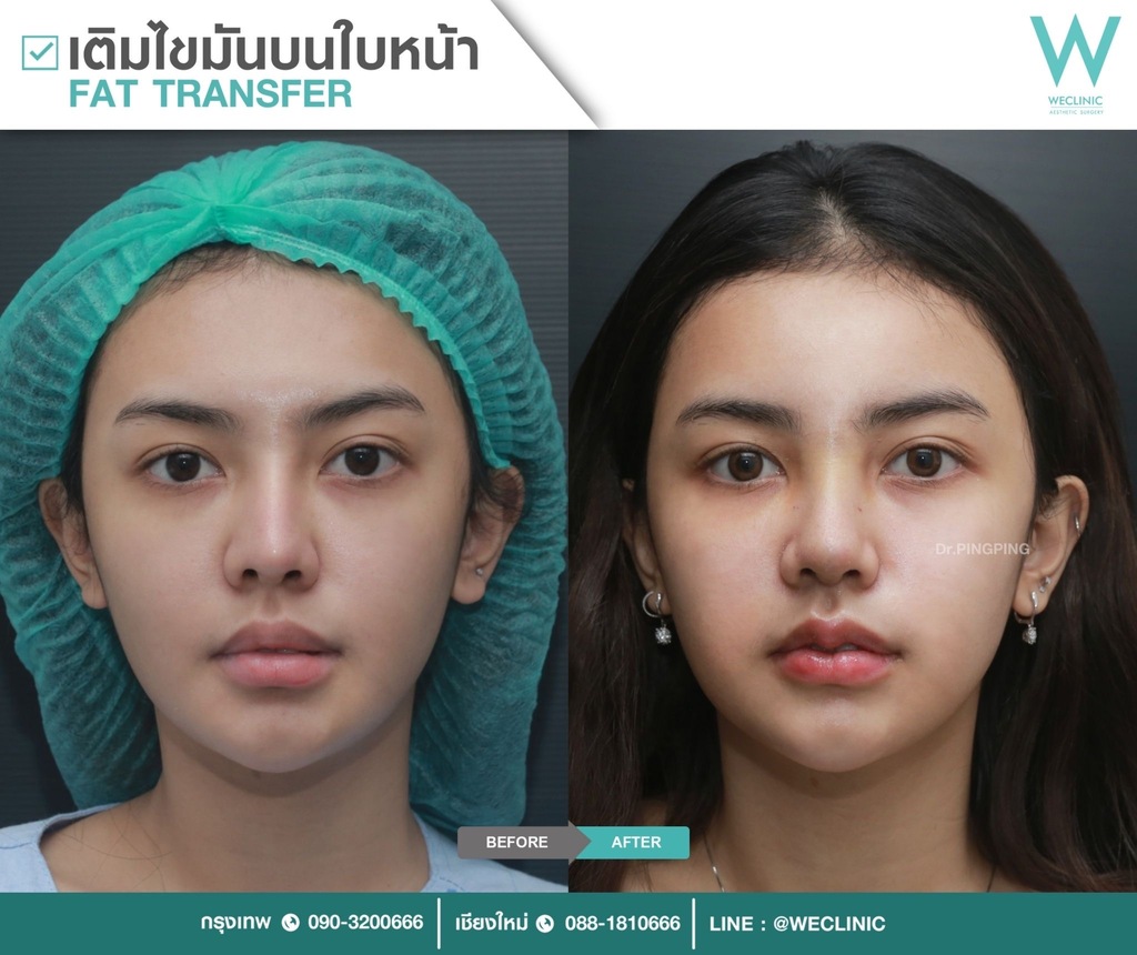 ก่อนหลังเติมไขมันหน้า-case-4-F21