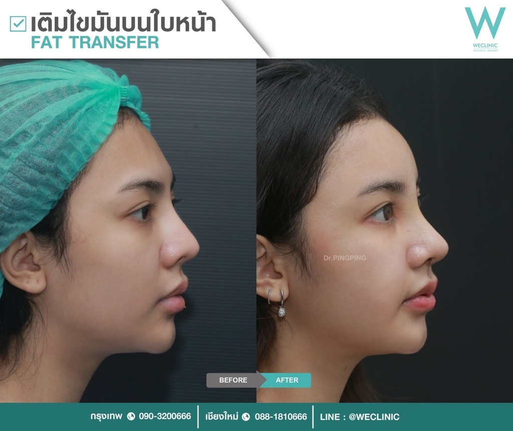 ก่อนหลังเติมไขมันหน้า-case-4-F22