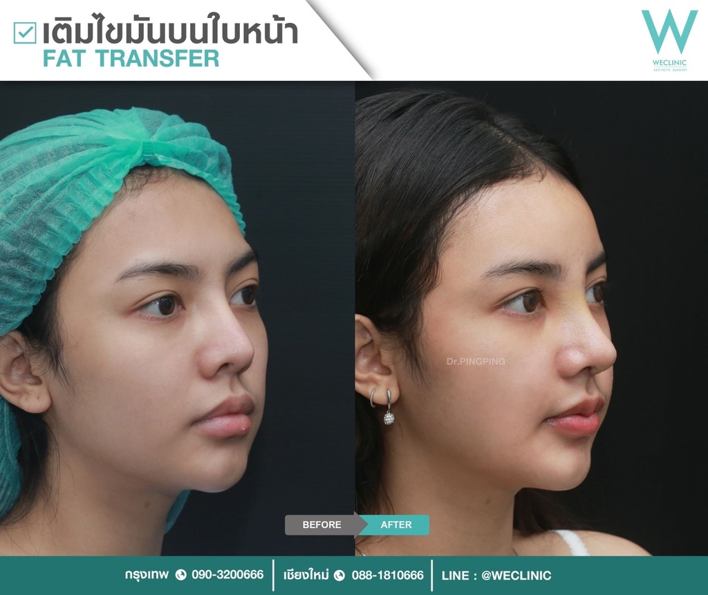 ก่อนหลังเติมไขมันหน้า-case-4-F23