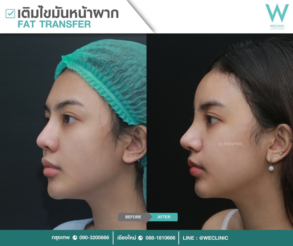 ก่อนหลังเติมไขมันหน้า-case-4-F24