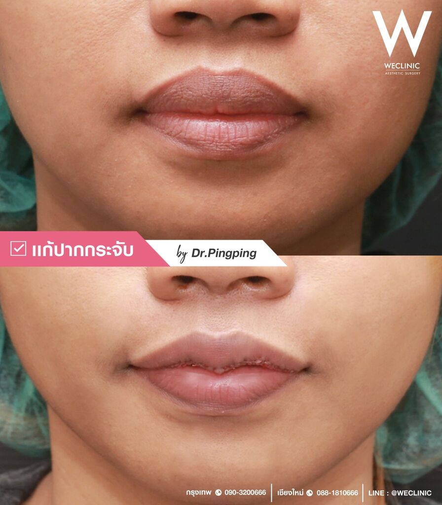 ปากคว่ำแก้ไขได้ไหม