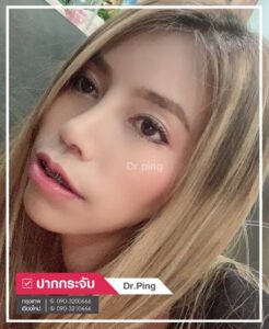 รีวิวแก้ไขปากคว่ำ-U10