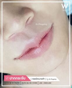 รีวิวแก้ไขปากคว่ำ-U17