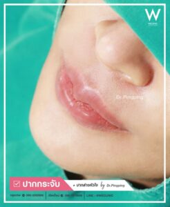 รีวิวแก้ไขปากคว่ำ-U18