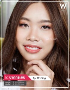 รีวิวแก้ไขปากคว่ำ-U7