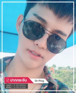 รีวิวแก้ไขปากคว่ำ-U8