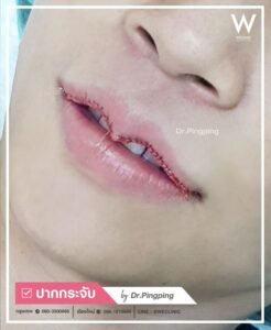รีวิวแก้ไขปากคว่ำ-U9-คุณหมอปิงปิง เย็บแผลละเอียด ปากกระจับ ไม่บางเกิน หลังทำทันที ปากกระจับปีกนกยกมุมปาก