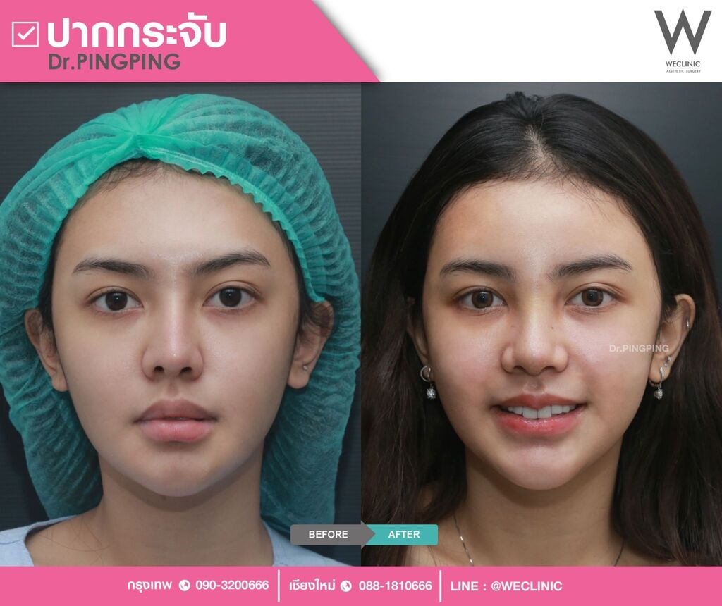 ลักษณะของปากคว่ำ