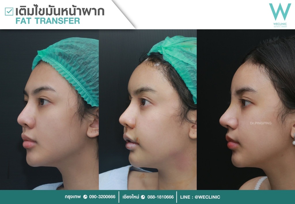 เติมไขมันหน้าผาก