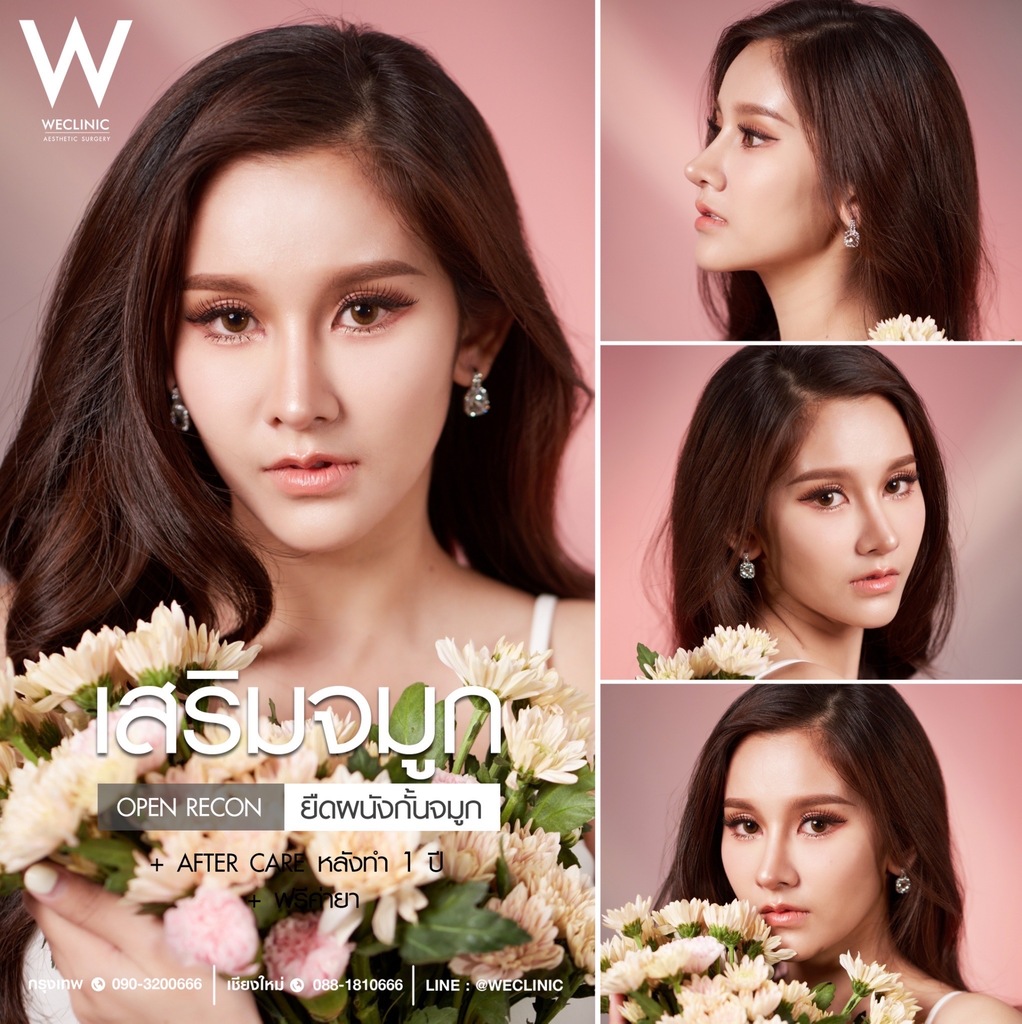 เสริมจมูกกระดูกอ่อนซี่โครง-04