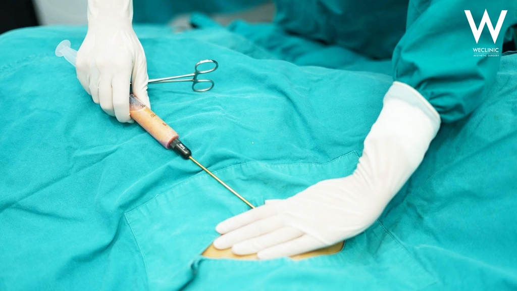 แพทย์จะทำการเปิดแผลขนาดเล็กบริเวณที่มีไขมันส่วนเกิน