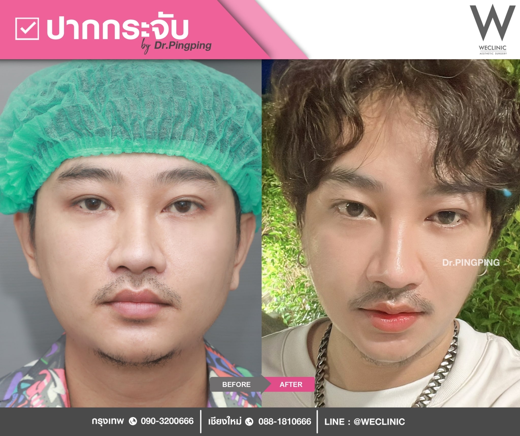 1-ปากกระจับ ผู้ชาย