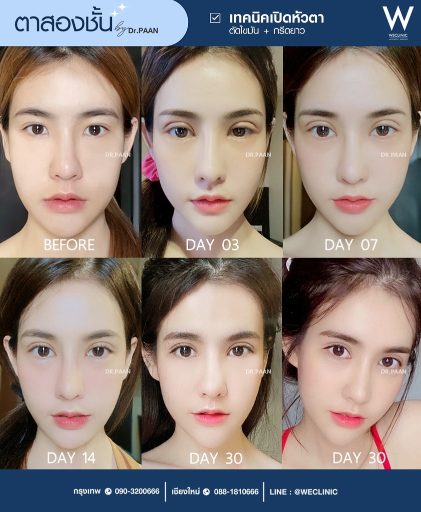การดูแลหลังทำตาสองชั้น