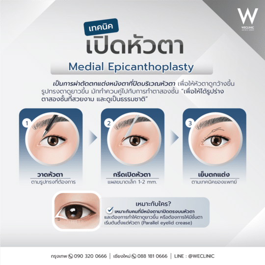 การศัลยกรรมตาเทคนิคการเปิดหัวตา