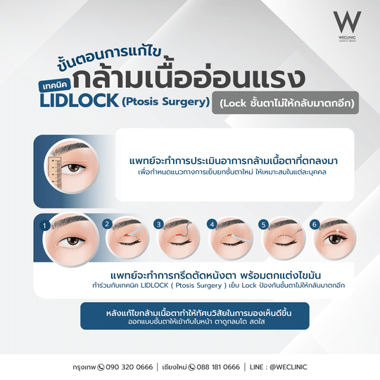 การศัลยกรรมตาเพื่อแก้ไขกล้ามเนื้อตาอ่อนแรง