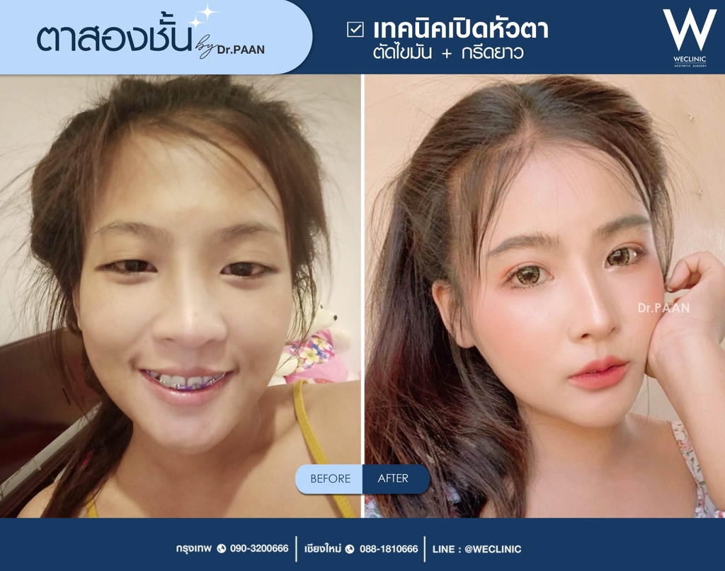 คนตาตี่ ตาชั้นเดียว ทำตาสองชั้น