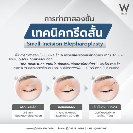 ทำตาสองชั้นเทคนิคกรีดสั้น