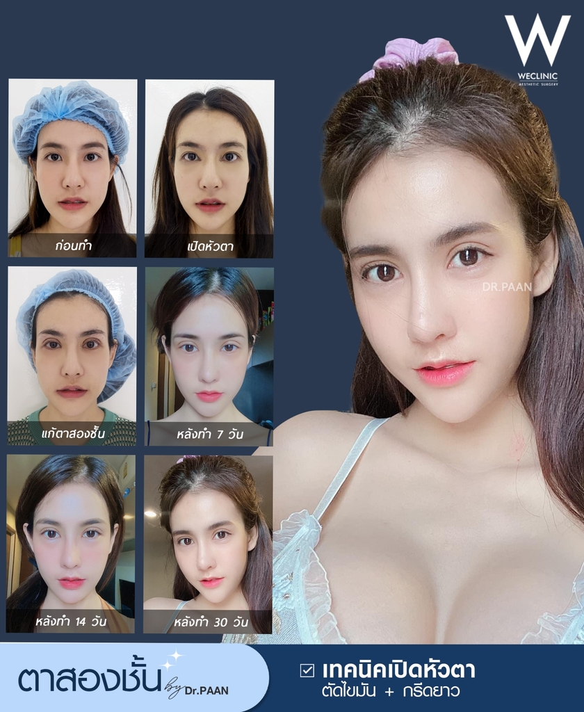 ผ่าตัดตาสองชั้นหน้าเปลี่ยนไหม