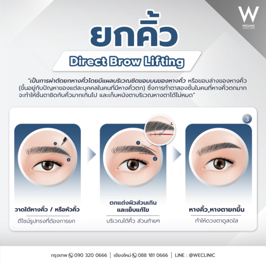 ยกคิ้ว direct brow lifting